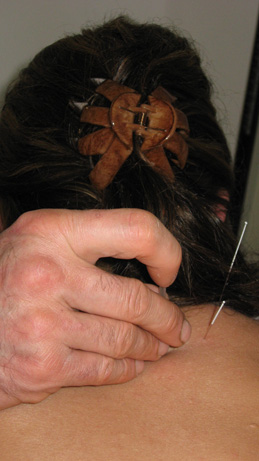 Dr. Gregg Hebeisen performing acupuncture at Advanced Health PA Dr. Gregg Hebeisen performing acupuncture at Advanced Health PA